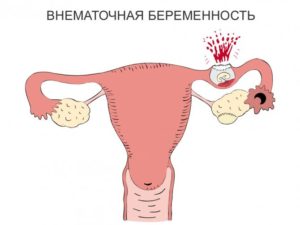 Выделения При Внематочной Беременности На Ранних Сроках