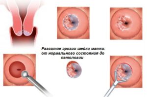 Коричневые выделения при беременности после осмотра шейки матки