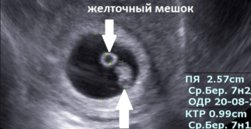 Плодное яйцо 14 мм эмбрион не визуализируется