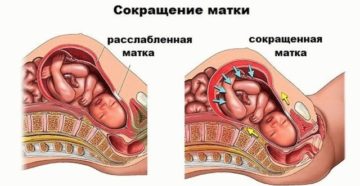 Тонус на 30 неделе беременности симптомы