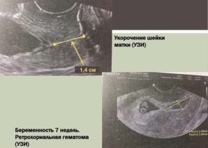 Ретрохориальная гематома в матке при беременности на ранних сроках размеры