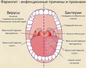 Вирусный Фарингит Симптомы И Лечение У Детей