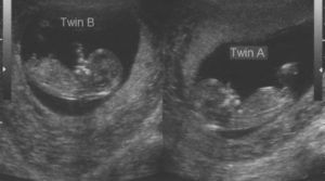 13 Неделя беременности двойней фото