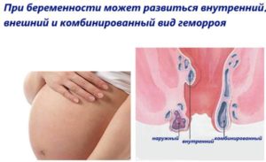 Геморрой на 38 неделе беременности что делать