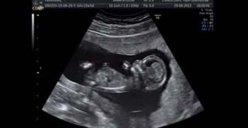 Низкая плацента 13 неделе беременности