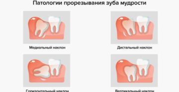 Как помочь зубу мудрости прорезаться