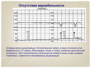 Как Подготовиться К Ктг При Беременности