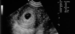 Беременность 4 недели фото плода на узи