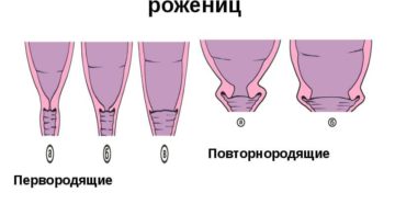 Открыта шейка матки без беременности