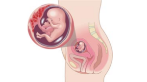 Токсикоз При Беременности На 12 Неделе Беременности