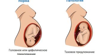 31 неделя беременности тазовое предлежание перевернется или нет