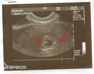 Толщина эндометрия 4 неделе беременности