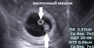 Нет эмбриона в плодном яйце 7 акушерских недель