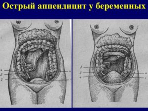 Аппендицит при беременности симптомы форум