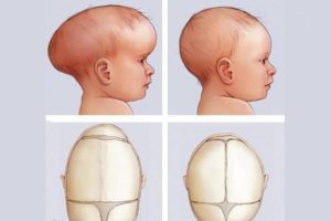 Долихоцефалическая форма головки плода причины