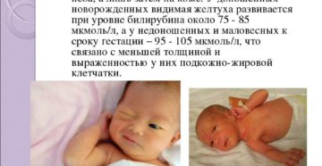 Желтуха У Новорожденных Когда Должна Пройти Комаровский