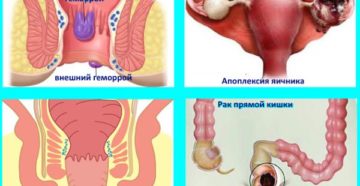 Боль При Овуляции Отдает В Прямую Кишку