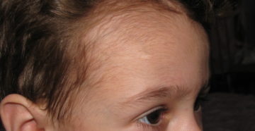 Волосы у ребенка на лбу
