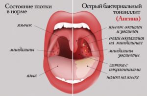 Горло Красное У Ребенка Чем Лечить Отзывы