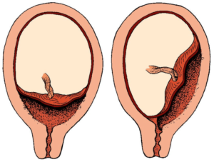 Эмбрион прикрепился к задней стенке матки
