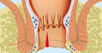 После родов трещины заднего прохода