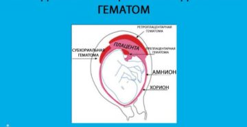 Гематома при беременности в стадии организации что это