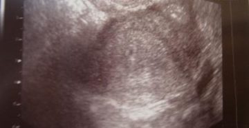 Почему не видно плодное яйцо на узи на ранних сроках беременности