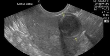 Миома 20 недель это опасно