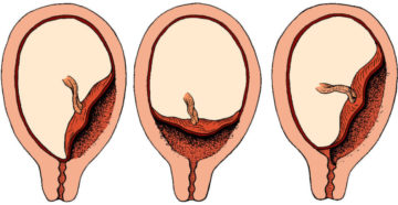 Плод прикрепился низко в матке