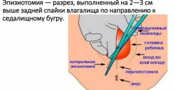 Почему после эпизиотомии нельзя сидеть