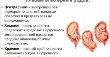 Плацента по задней стенке матки перекрывает внутренний зев