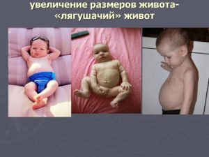 Лягушачий Живот У Ребенка При Рахите Фото