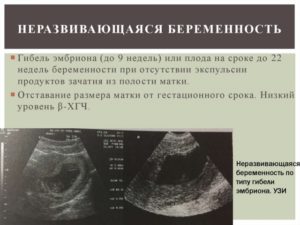 Признаки замершей беременности на 7 неделе беременности