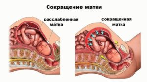 Сколько лежат в больнице с тонусом матки при беременности