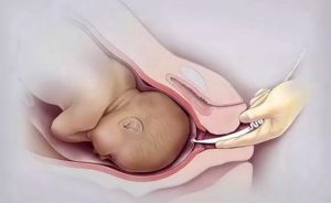 Гипоксия на 38 неделе беременности
