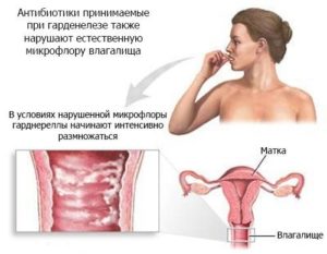 Гарднерелла у женщин симптомы и лечение при беременности