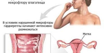 Гарднерелла у женщин симптомы и лечение при беременности
