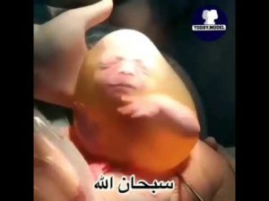 Видео ребенок родился в пузыре