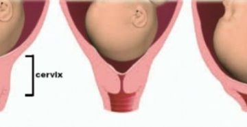 Шейка Матки Мягкая На 36 Неделе Беременности