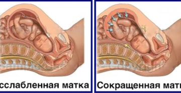 Воздух из матки при беременности на ранних сроках
