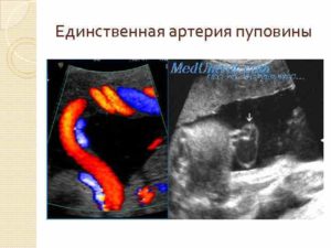 Единственная артерия пуповины при беременности причины и последствия
