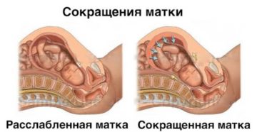 Может Ли Быть Тонус Матки Без Беременности