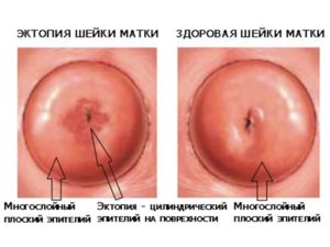 Синюшная шейка матки причины кроме беременности