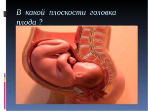 Низкое расположение головки плода при беременности на 33 неделе