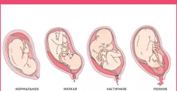 Низкое расположение плаценты при беременности 22 недели