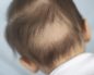 Ребенку 3 месяца волосы выпадают