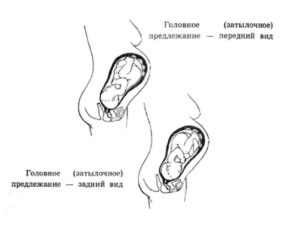 Задний вид головное предлежание 2 позиция