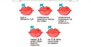 Простуда на губе при беременности 2 триместр последствия для малыша