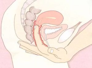 Можно ли достать пальцем до шейки матки при беременности