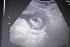 Определение пола на 17 неделе беременности фото